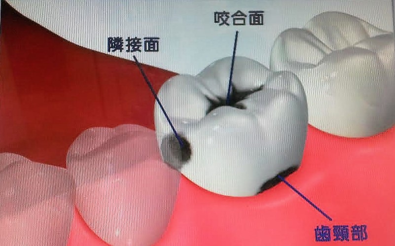 馬場ブロ虫歯1