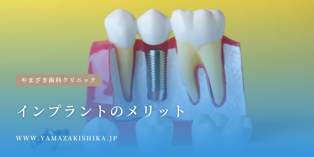 インプラントのメリット