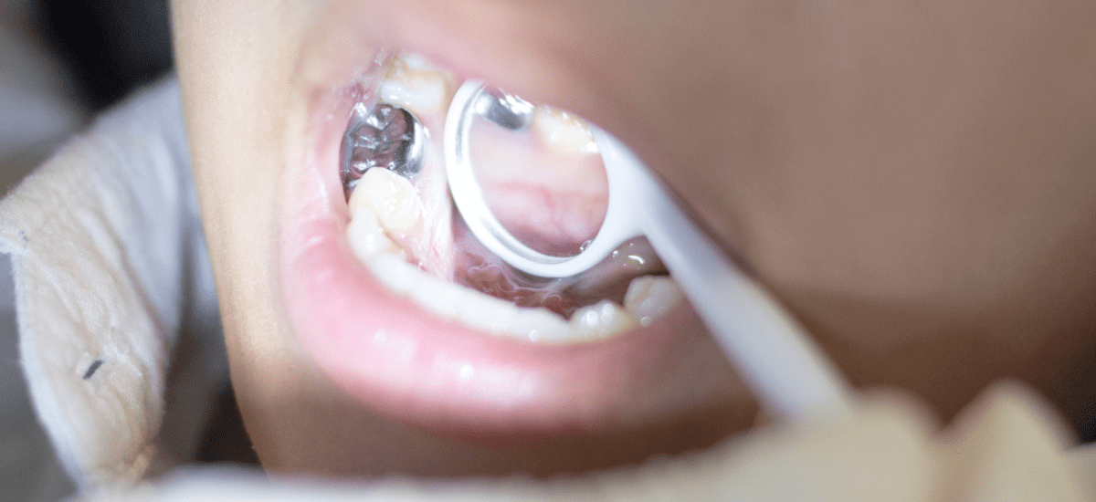 歯の表面を保護するシーラント
