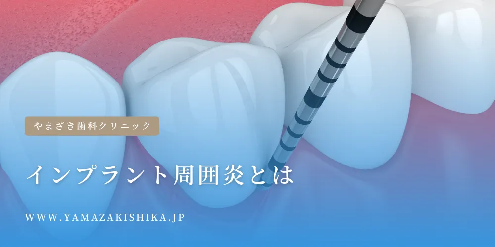 2024年7月12日_インプラント周囲炎とは